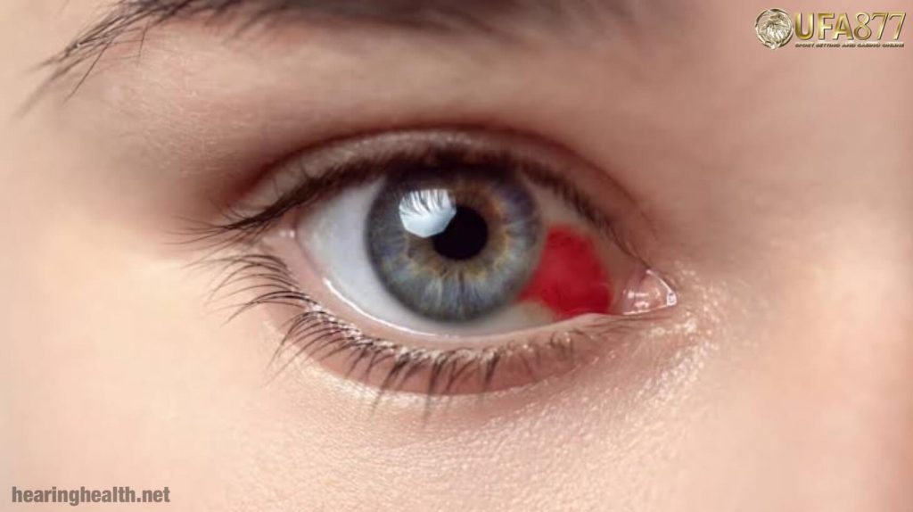 เส้นเลือดในตาแตก ( เลือดออกใต้เยื่อบุตา ) อันตรายไหม?