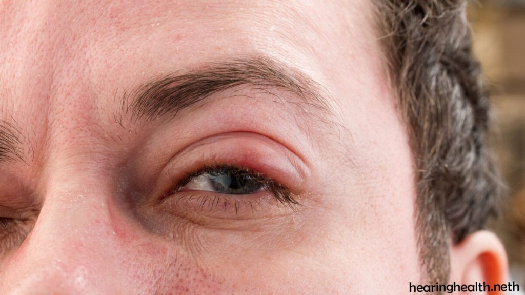 โรคริดสีดวงตา ทำให้สูญเสียการมองเห็นและตาบอดมากกว่าการติดเชื้ออื่นๆ ในโลก คือการติดเชื้อแบคทีเรียที่ส่งผลต่อดวงตาของคุณ
