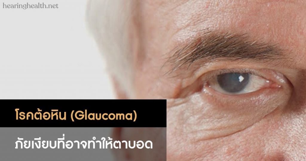 โรคต้อหิน เป็นกลุ่มอาการตาที่ทำลายเส้นประสาทตา เส้นประสาทตาส่งข้อมูลการมองเห็นจากดวงตาของคุณไปยังสมองและมีความสำคัญต่อการมองเห็นที่ดี