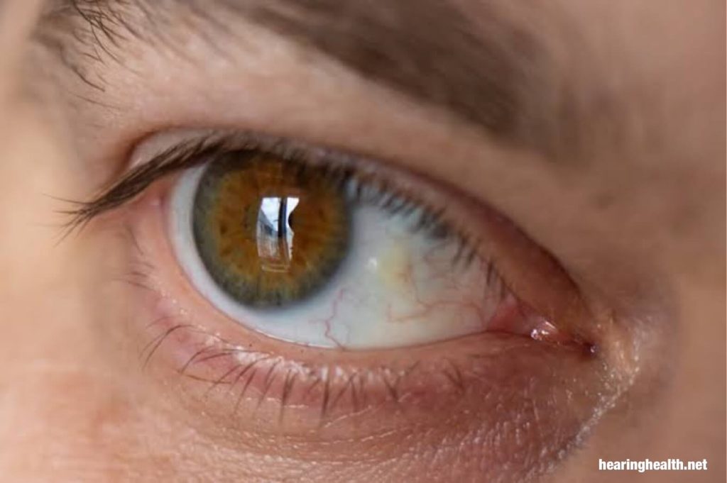 ดวงตาสีเหลือง  เกิดขึ้นเมื่อตาขาว เปลี่ยนเป็นสีเหลือง เรียกว่า scleral icterus มันเป็นสัญญาณของโรคดีซ่าน ซึ่งเป็นอาการของเงื่อนไขพื้นฐานของตับ 