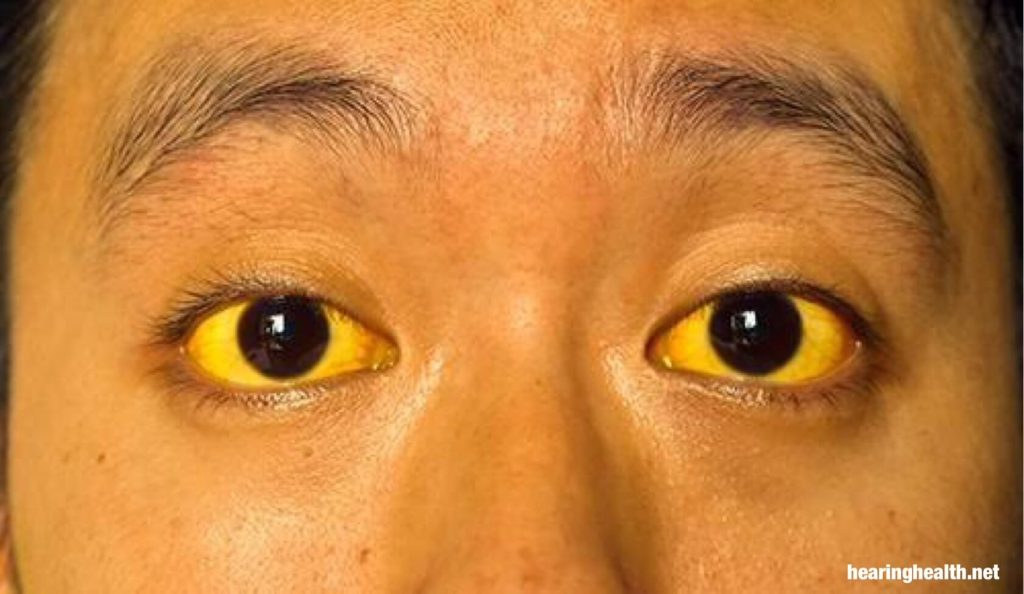 ดีซ่านเป็นภาวะที่ตาขาวเปลี่ยนเป็นสีเหลือง ผิวของคุณอาจใช้สีเหลือง โดยทั่วไป ดีซ่านเกิดจากเงื่อนไขพื้นฐานที่ร่างกายสร้างขึ้นสารสีเหลือง