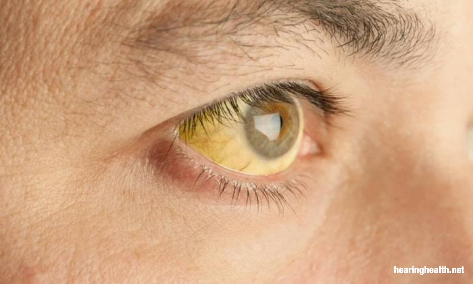 ดีซ่านเป็นภาวะที่ตาขาวเปลี่ยนเป็นสีเหลือง