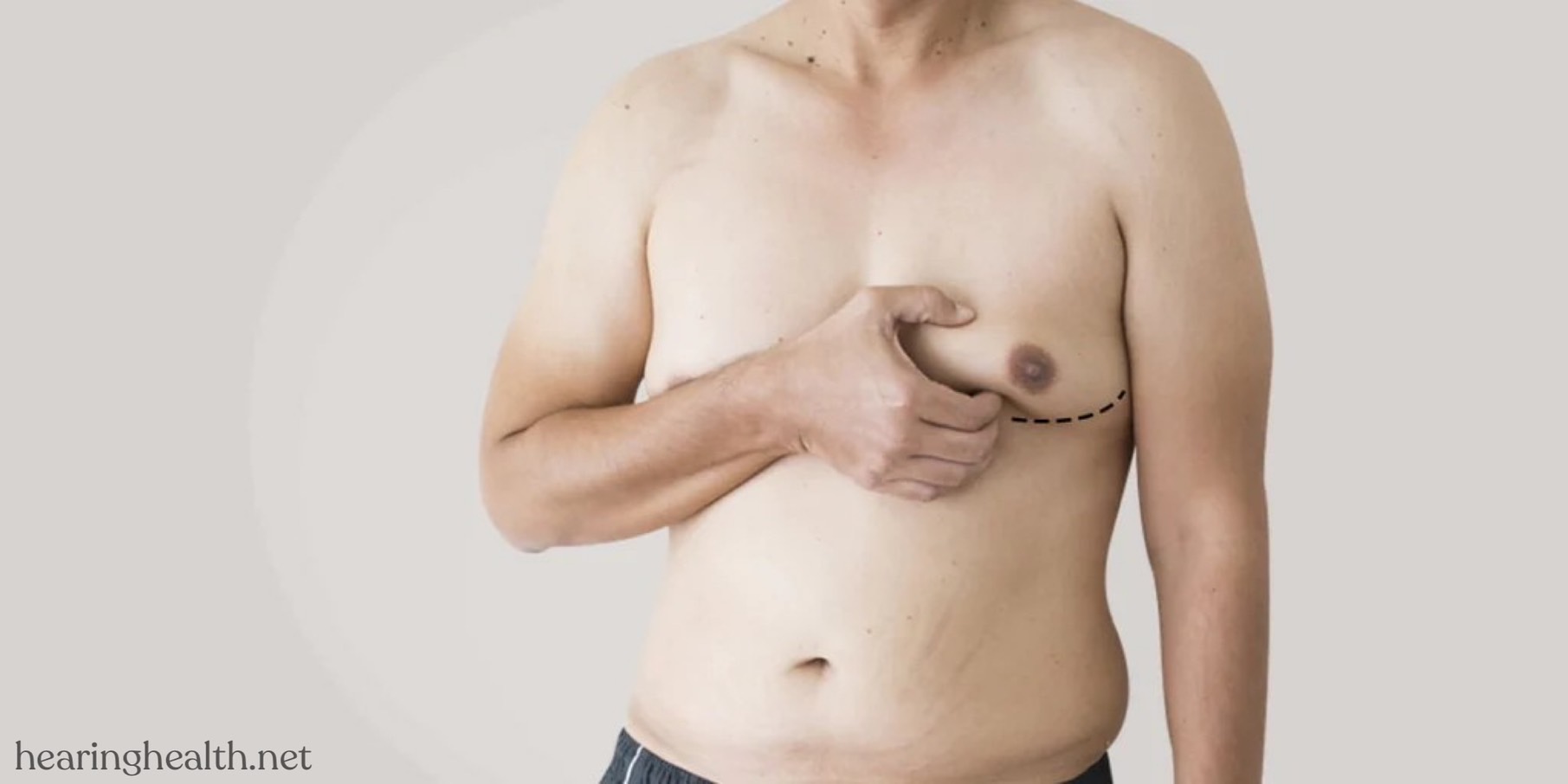 ภาวะ Gynecomastia ภาวะเต้านมโตในผู้ชาย