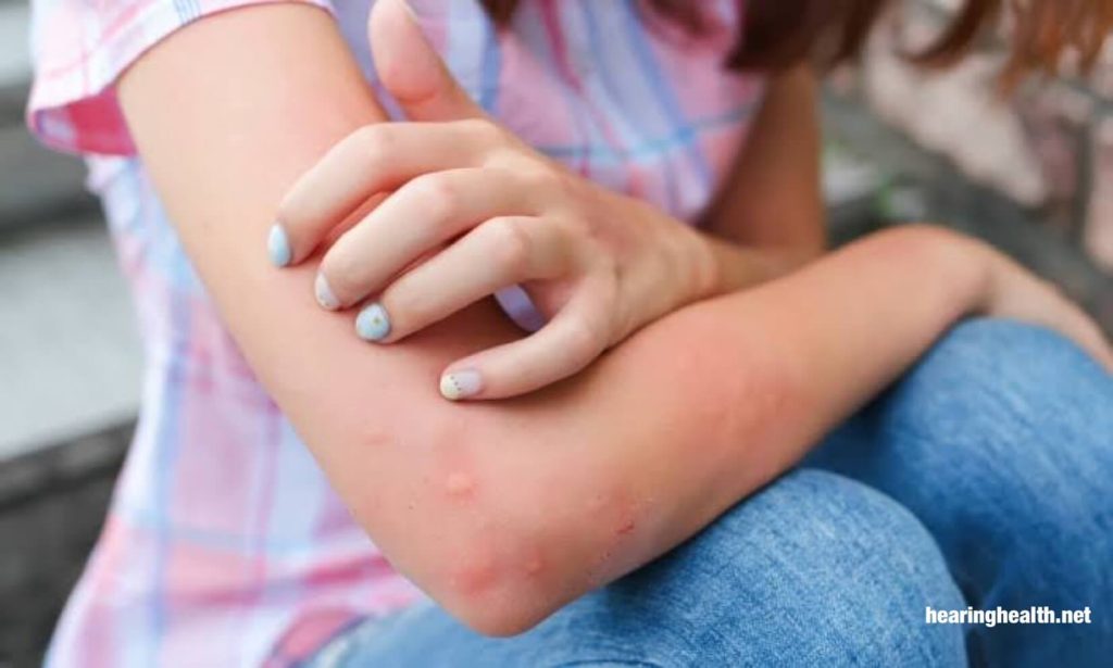 อาการแพ้ยุง เราหลายคนใช้เวลาอยู่ข้างนอกมากขึ้น และเราพบว่าตัวเองต้องเผชิญกับยุงกัด ที่น่ารำคาญและคัน มากขึ้น สำหรับพวกเราส่วนใหญ่ 